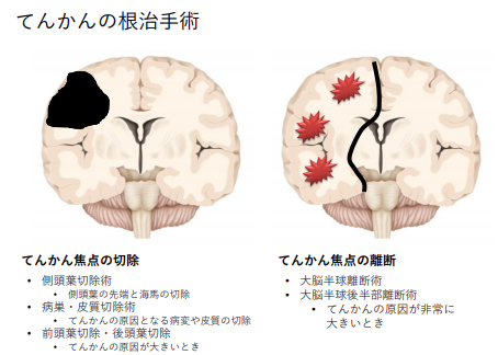 癲癇日本手術(shù)治療