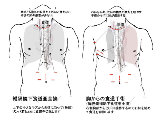 高齡食道癌患者治療