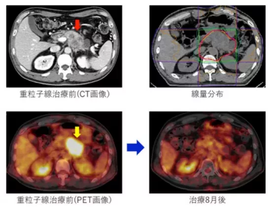 胰腺癌質(zhì)子治療