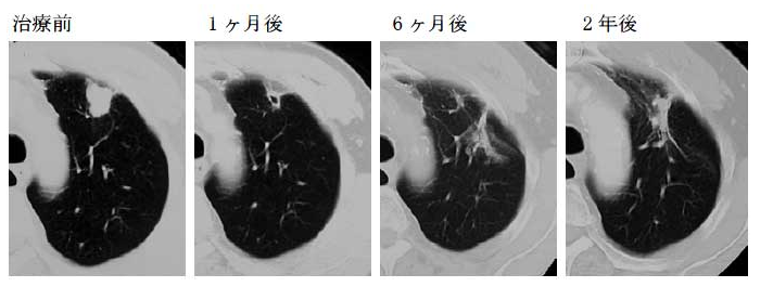 肺癌質子重離子治療