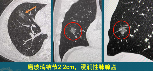 肺磨玻璃結節(jié) 肺癌