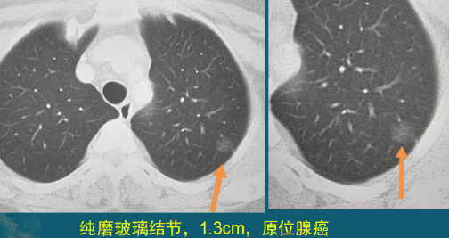 肺磨玻璃結節(jié) 肺癌