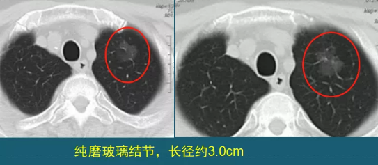 肺磨玻璃結節(jié) 肺癌