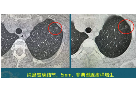 肺磨玻璃結節(jié) 肺癌