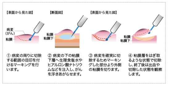 日本食道癌治療