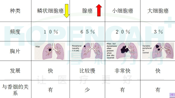 小細(xì)胞肺癌出國看病