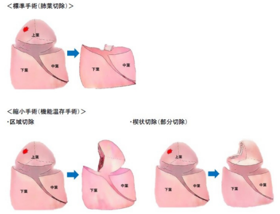 肺癌能治好嗎