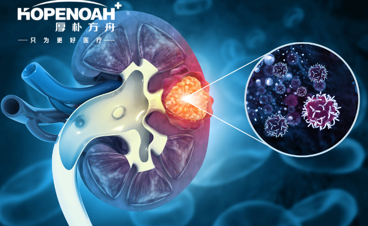 國外腎癌生存率-日本腎癌治療方法