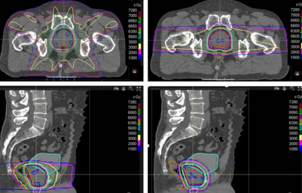 前列腺癌看病指南:前列腺癌放療選擇質(zhì)子治療優(yōu)勢(shì)