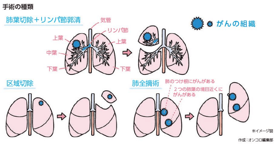 小細胞肺がんの治療－手術(shù)療法